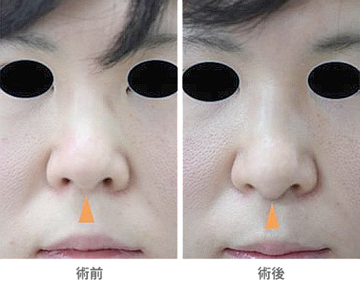 「鼻柱下降術（鼻橋部耳介軟骨移植・鼻柱延長／クローズ法）」の症例写真・ビフォーアフター