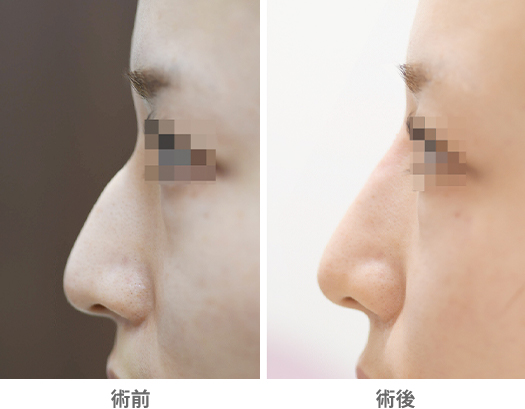 「ヒアルロン酸によるワシ鼻修正術（手術不要）」の症例写真・ビフォーアフター