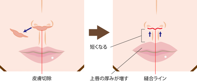 皮膚切除