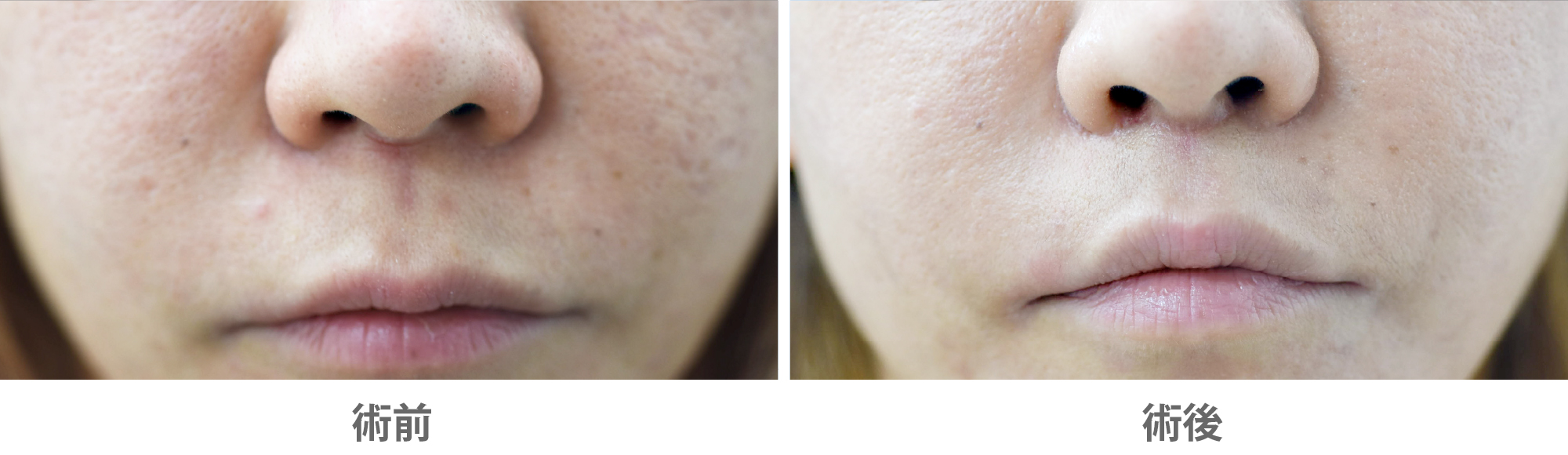 「人中短縮術・リップリフト」の症例写真・ビフォーアフター