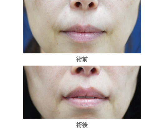 「人中短縮・口角挙上（皮膚切開）※傷跡改善ボトックス併用」の症例写真・ビフォーアフター