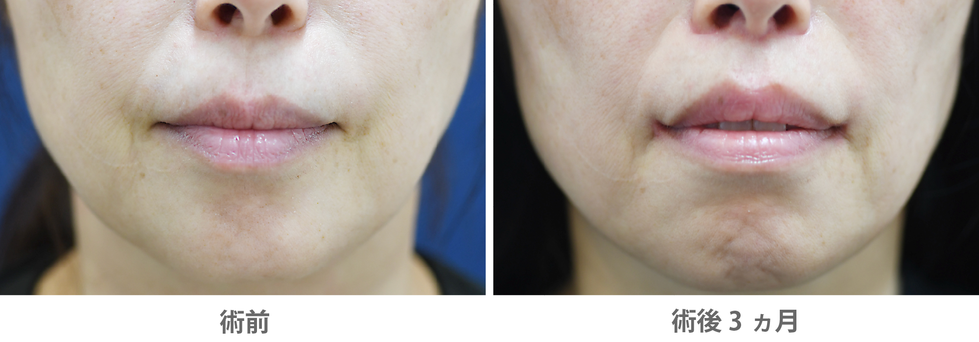 「人中短縮・口角挙上（皮膚切開）※傷跡改善ボトックス併用」の症例写真・ビフォーアフター