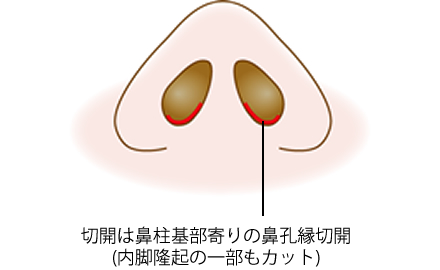 切開