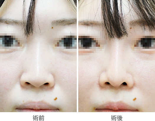 「貴族手術（鼻翼基部プロテーゼ／鼻孔内アプローチ）」の症例写真・ビフォーアフター
