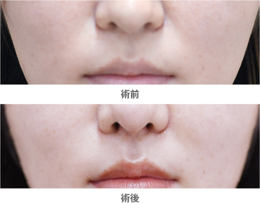 「貴族手術（鼻翼基部プロテーゼ／鼻腔内アプローチ）」の症例写真・ビフォーアフター