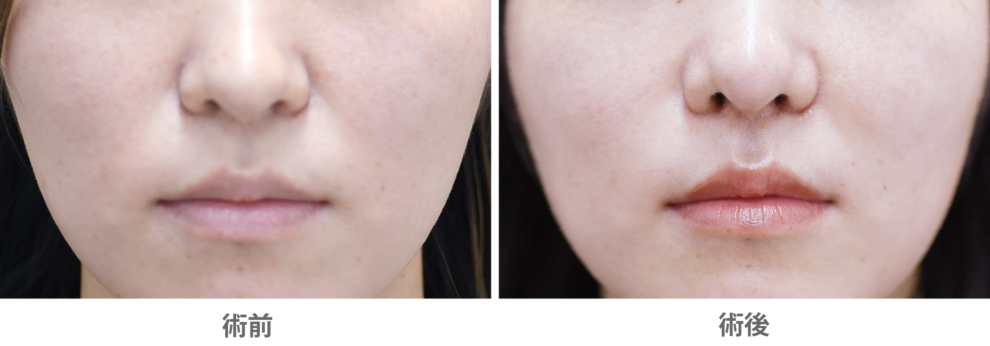 「貴族手術（鼻翼基部プロテーゼ／鼻腔内アプローチ）」の症例写真・ビフォーアフター