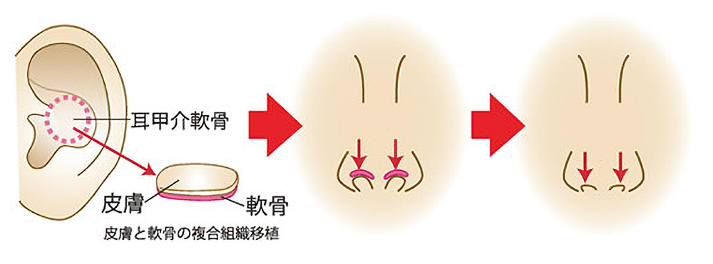 鼻孔縁下降術とは