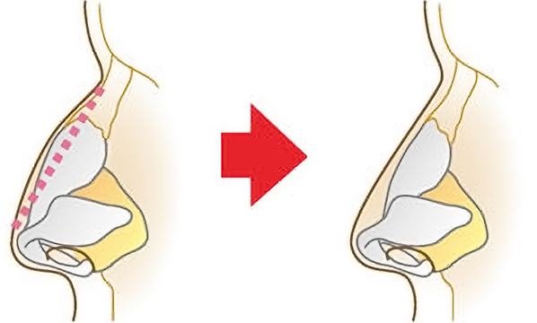 鼻骨骨削り(ハンプ除去・ハンプ削り・ワシ鼻整形)