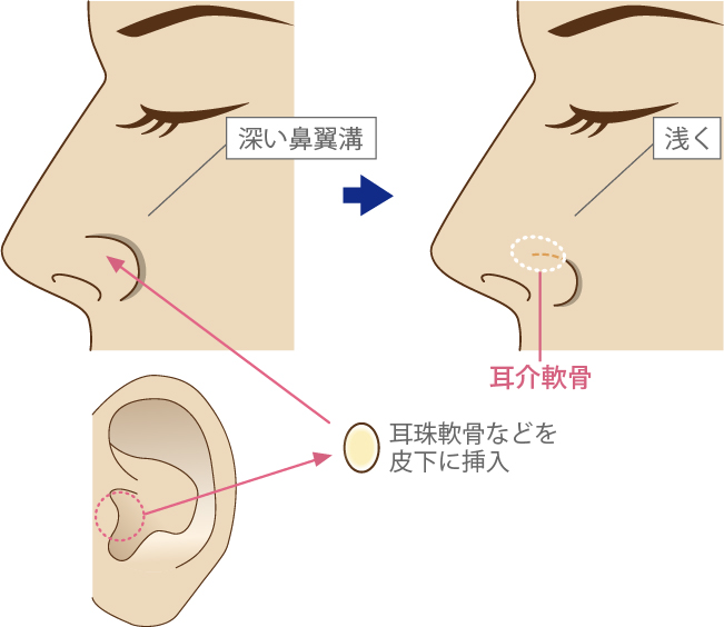 鼻翼溝修正