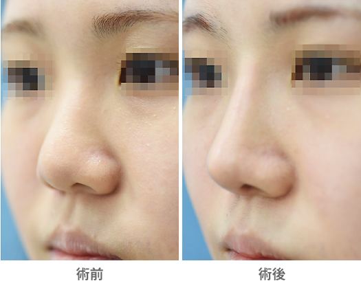 「魅せ鼻整形（プロテーゼ・鼻中隔延長）」の症例写真・ビフォーアフター