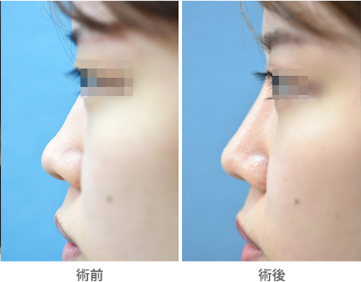 「プロテーゼ挿入・鼻先耳介軟骨移植」の症例写真・ビフォーアフター