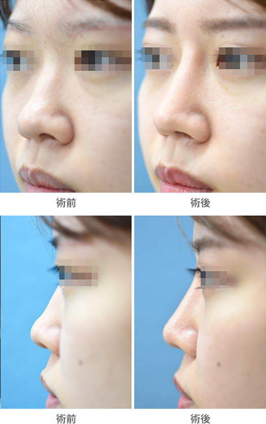 「鼻スジのわずかな歪み・うねりを整えるプロテーゼ術」の症例写真・ビフォーアフター