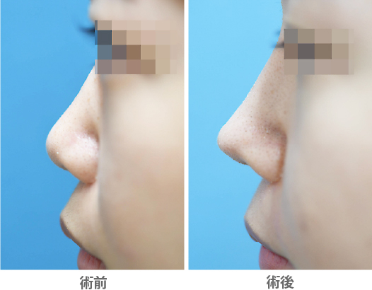 「鼻スジから鼻先までを高くシャープに（プロテーゼ＋鼻中隔延長術）」の症例写真・ビフォーアフター
