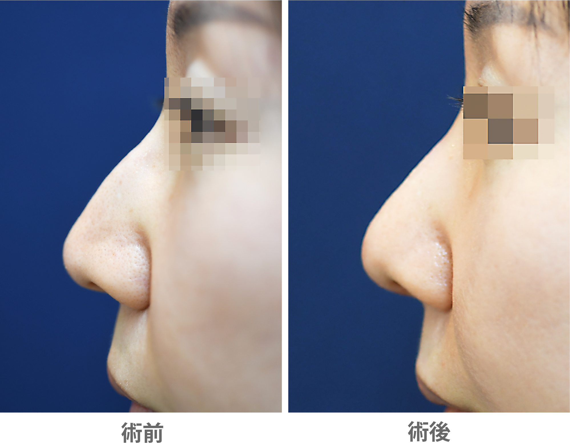 「ハンプ除去(斜鼻修正も併用)」の症例写真・ビフォーアフター