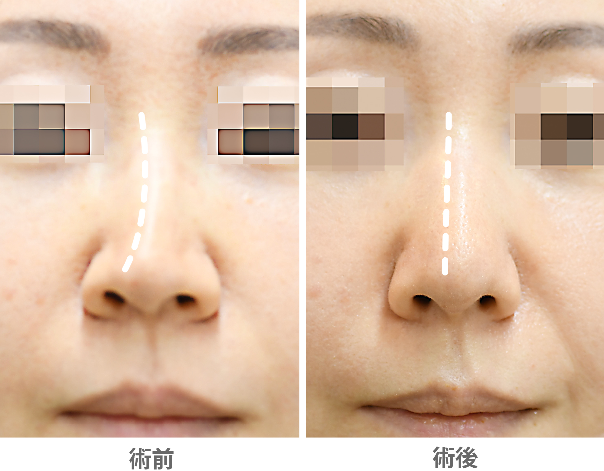 「鼻整形（斜鼻修正＋ハンプ修正）」の症例写真・ビフォーアフター