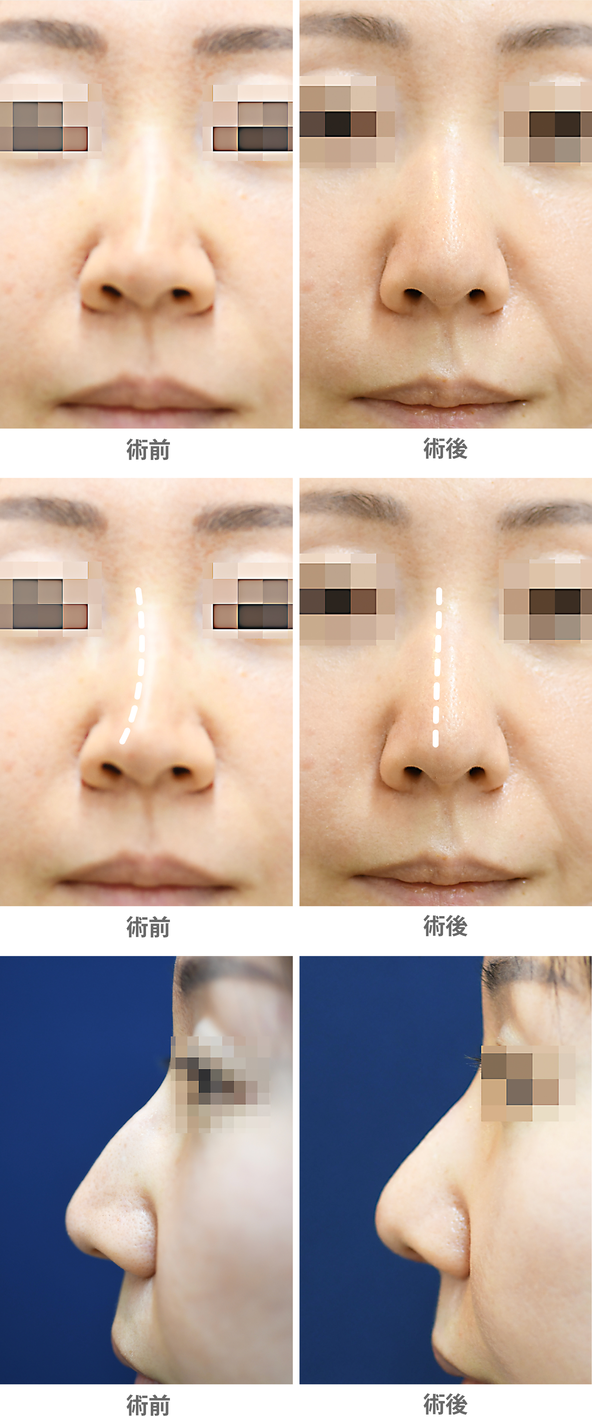 「斜鼻修正＋ハンプ除去」の症例写真・ビフォーアフター