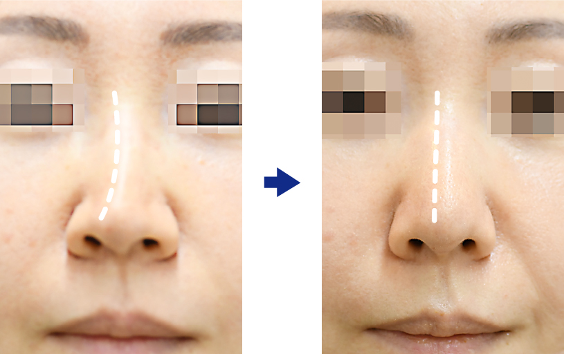 先天性のわずかな斜鼻の修正症例