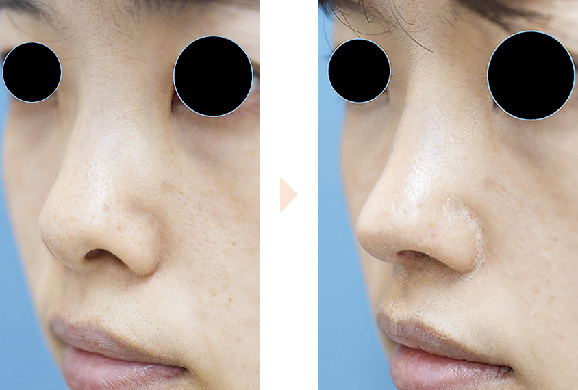 「前方・斜め方向から鼻の穴を目立たなくした症例」の症例写真・ビフォーアフター