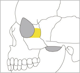 目の横の骨（頬骨前頭突起）も同時に後方へ移動します