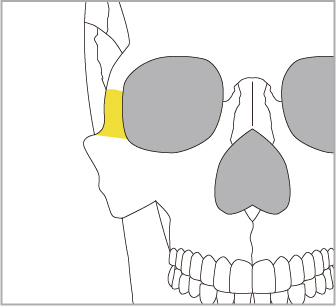 目の横の骨（頬骨前頭突起）も同時に後方へ移動します