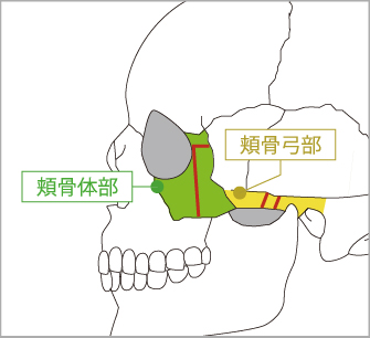 頬骨セットバックと頬骨整形による骨切りラインの違い