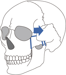 頬骨全体を後方へ移動
