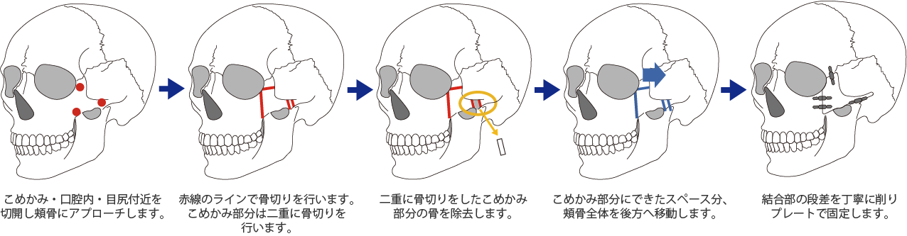 頬骨セットバックの手術の流れ