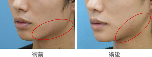 「Vライン形成／顎・下顎下縁・エラの骨切り・骨削り（エラ張り・顎先の左右差改善）」の症例写真・ビフォーアフター