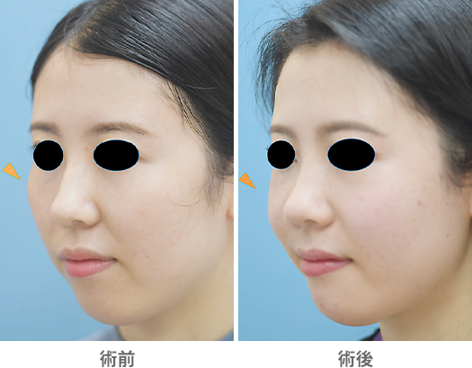 「頬骨削り術（体部+弓部）」の症例写真・ビフォーアフター