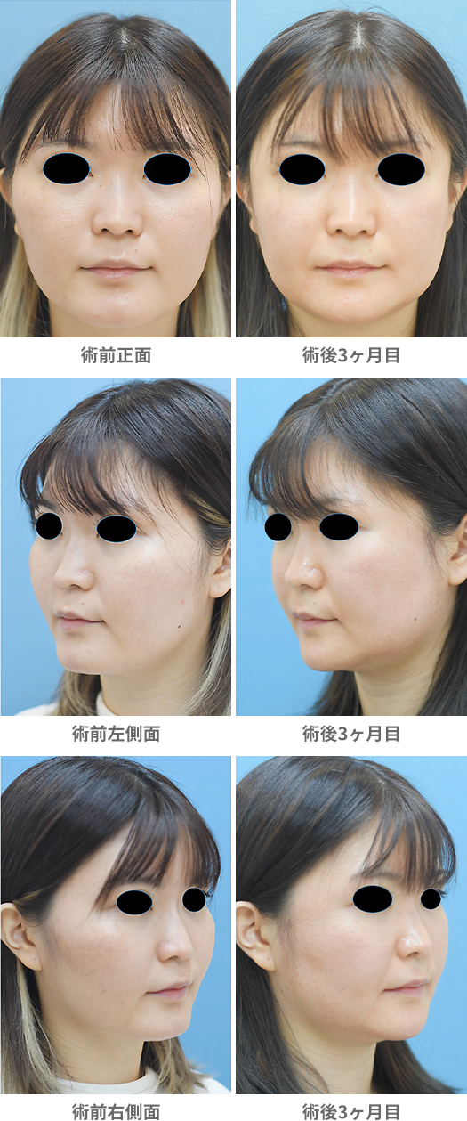「頬骨整形／頬骨骨切り・骨削り術（体部＋弓部／頬の突出・顔の余白改善）」の症例写真・ビフォーアフター