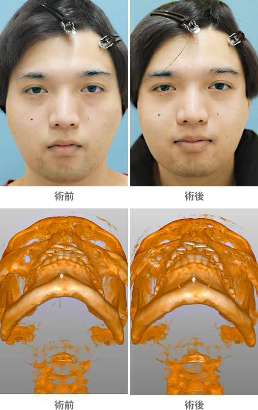 「頬骨整形／頰骨骨削り・頰骨骨切り／顔面骨CTあり（顔の横幅を縮めて小顔にする）」の症例写真・ビフォーアフター