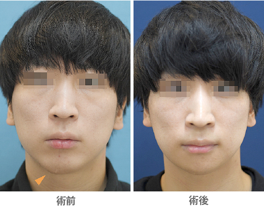 「おとがい形成（顎先の上下短縮＋左右差改善）」の症例写真・ビフォーアフター
