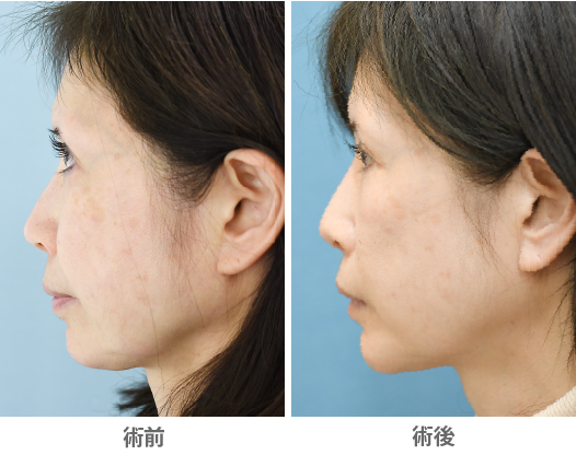 「プロテーゼ抜去後のおとがい形成（抜去後の顎先形成）」の症例写真・ビフォーアフター