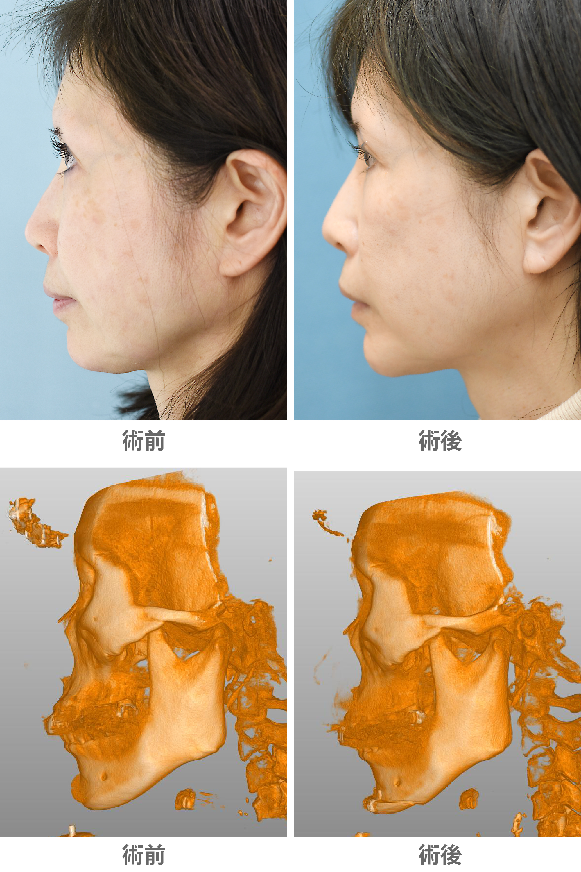 「プロテーゼ抜去後のおとがい形成(抜去後の顎先形成)」の症例写真・ビフォーアフター