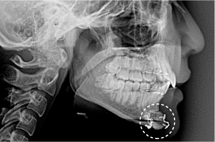 ピン・プレート除去の補足事項