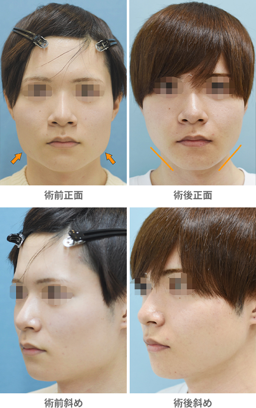 「エラ骨切り・下顎下縁形成術（エラ張りを複合施術で改善）」の症例写真・ビフォーアフター