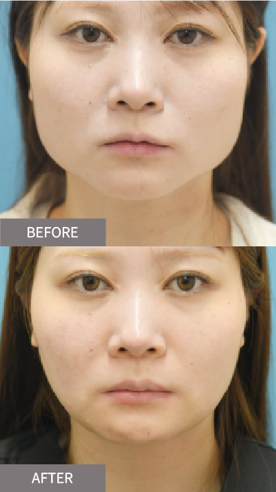 カベリン注射の施術変化