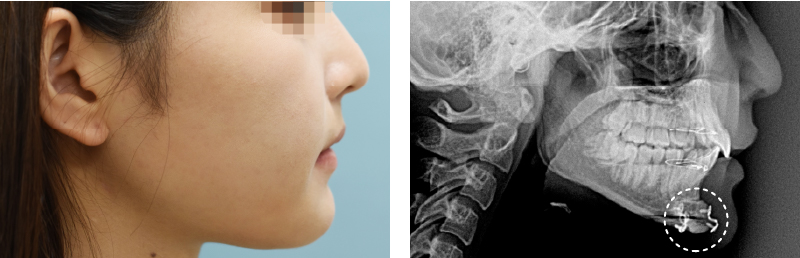 輪郭手術後の固定ピン除去とは