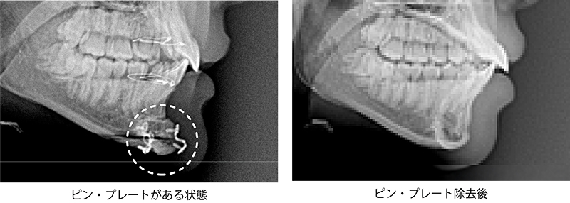輪郭手術後のピン除去