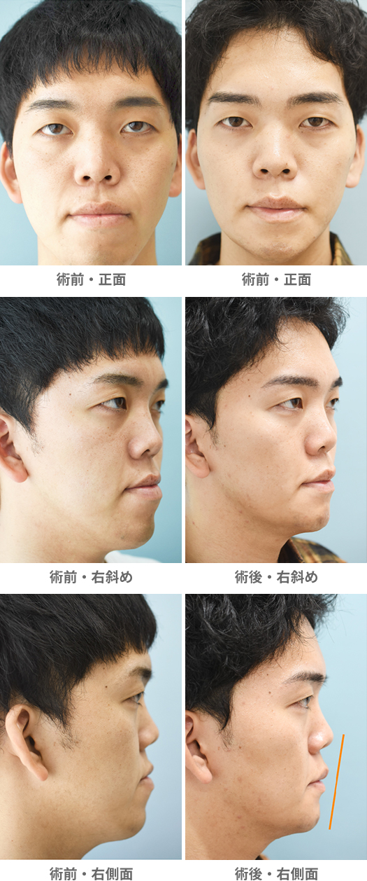 「下顎セットバック＋オトガイ形成（受け口・顎の長さ改善）」の症例写真・ビフォーアフター