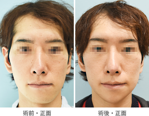 「Vライン形成／おとがい形成（面長整形）・下顎下縁切除（小顔整形・顎の左右差改善）」の症例写真・ビフォーアフター