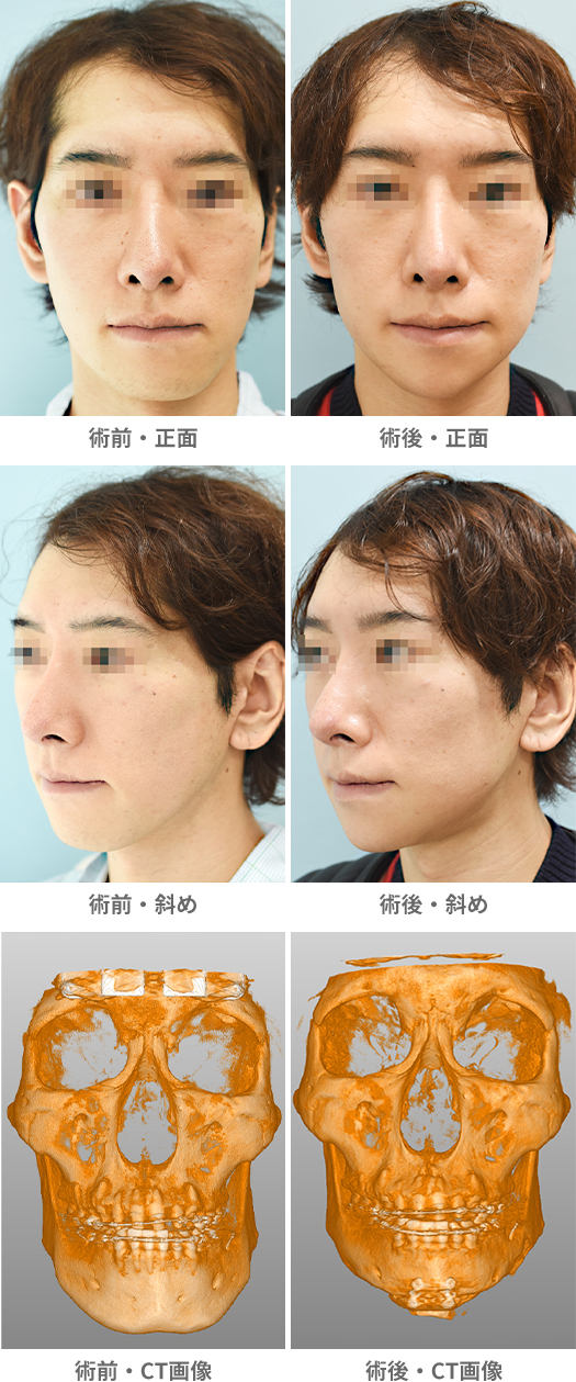 「Vライン形成／おとがい形成（面長整形）・下顎下縁切除（小顔整形・顎の左右差改善）」の症例写真・ビフォーアフター