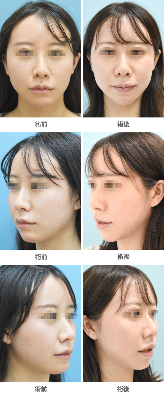 「Vライン形成(小顔整形+顎先の左右差改善)」の症例写真・ビフォーアフター