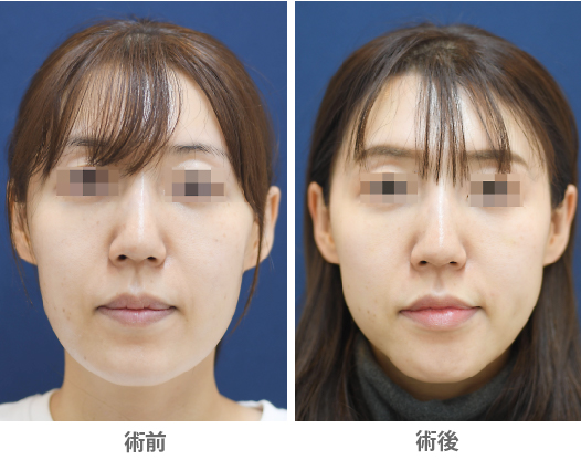 「Vライン形成／U字型の顎を尖りすぎない柔らかなVラインに」の症例写真・ビフォーアフター