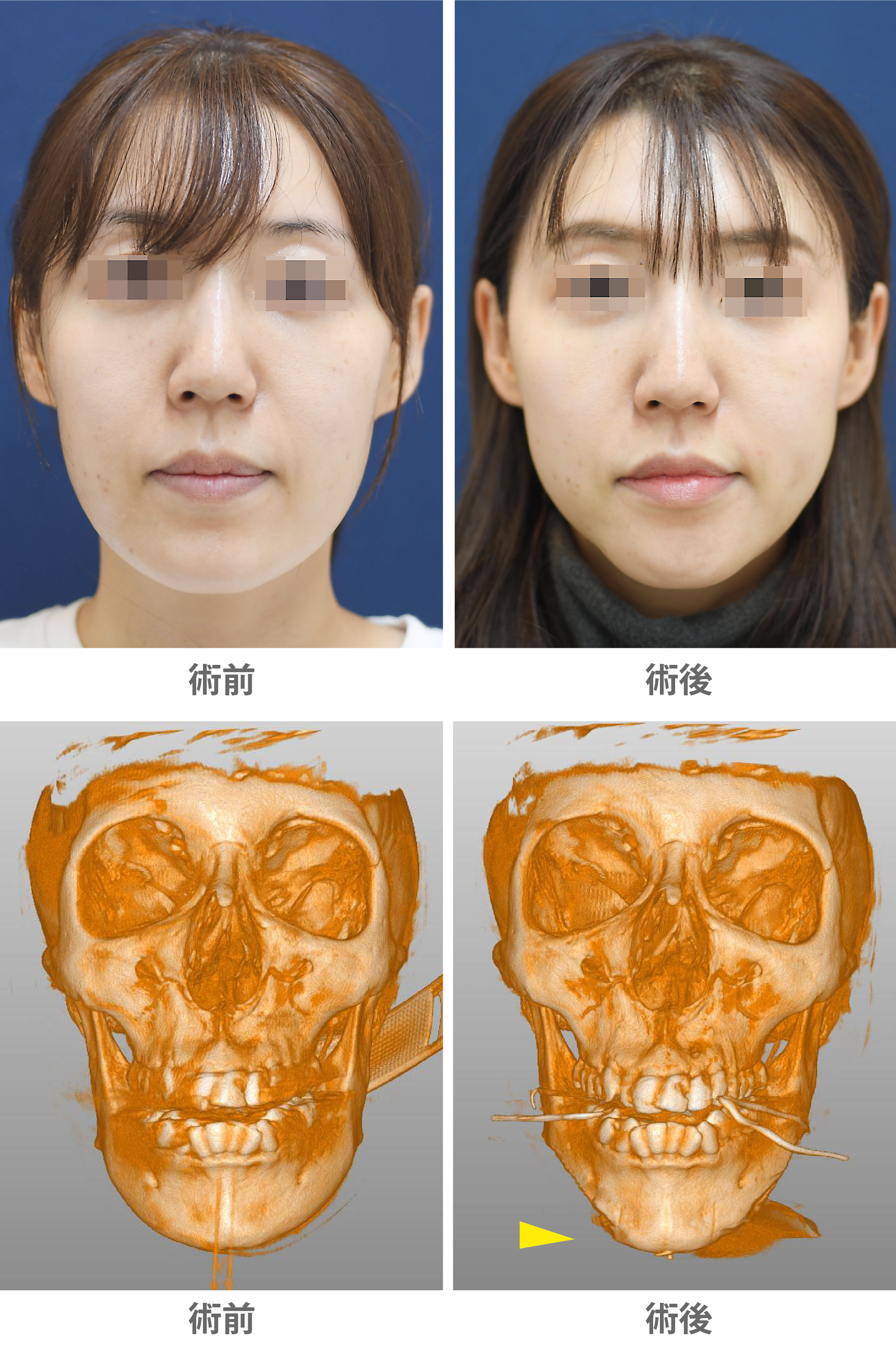 「Vライン形成／U字型の顎を尖りすぎない柔らかなVラインに」の症例写真・ビフォーアフター