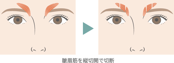 皺眉筋を縦切開で切断