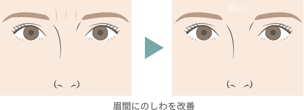 眉間にのしわを改善