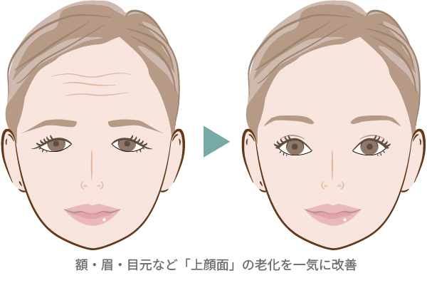 前額リフトの施術イメージ