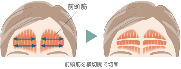 前頭筋切除を横切開で切断