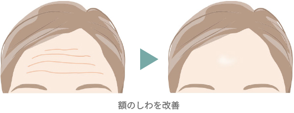 表情じわが消える